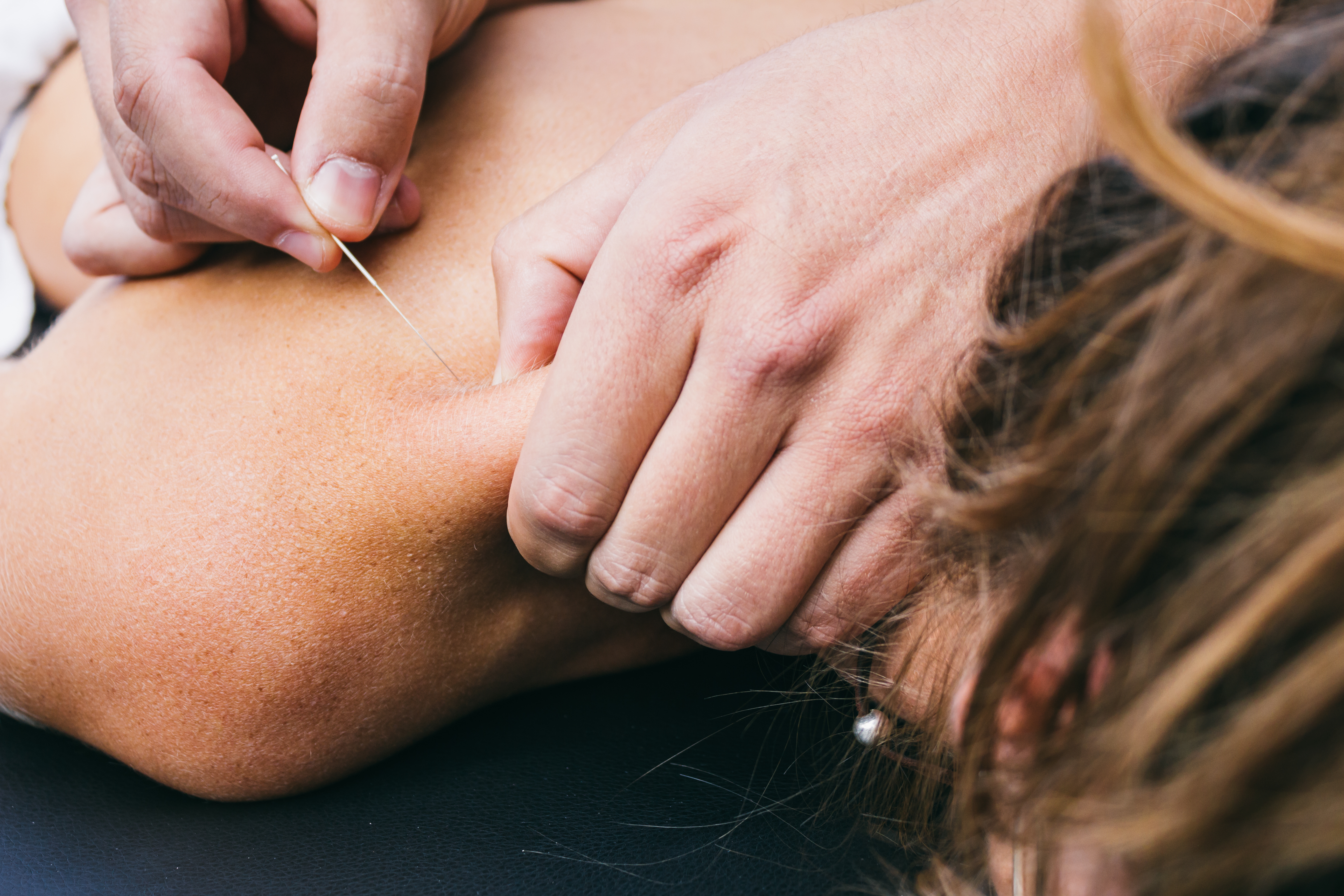 DRY NEEDLING