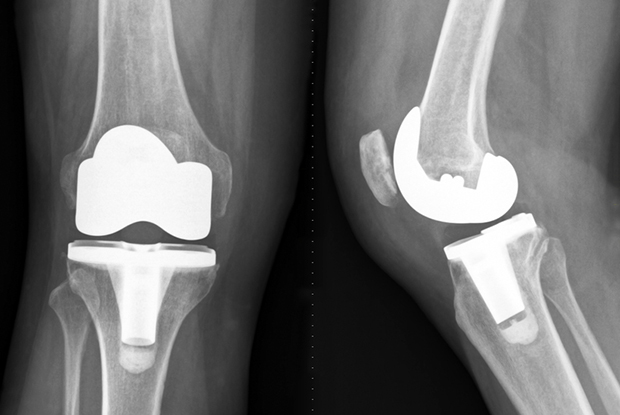 Best practice management – Total Knee replacement