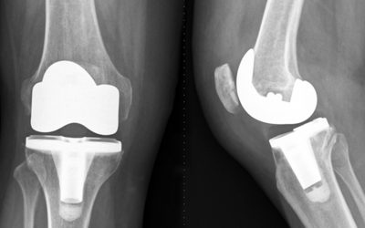 Best practice management – Total Knee replacement