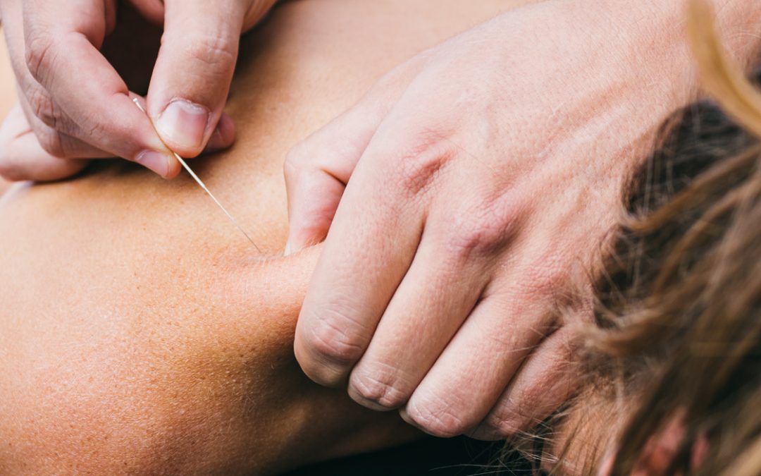 Dry needling