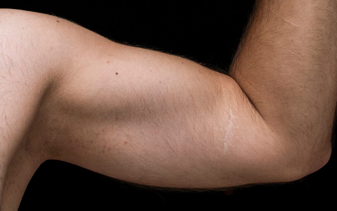 Shoulder Dislocations Made Simple